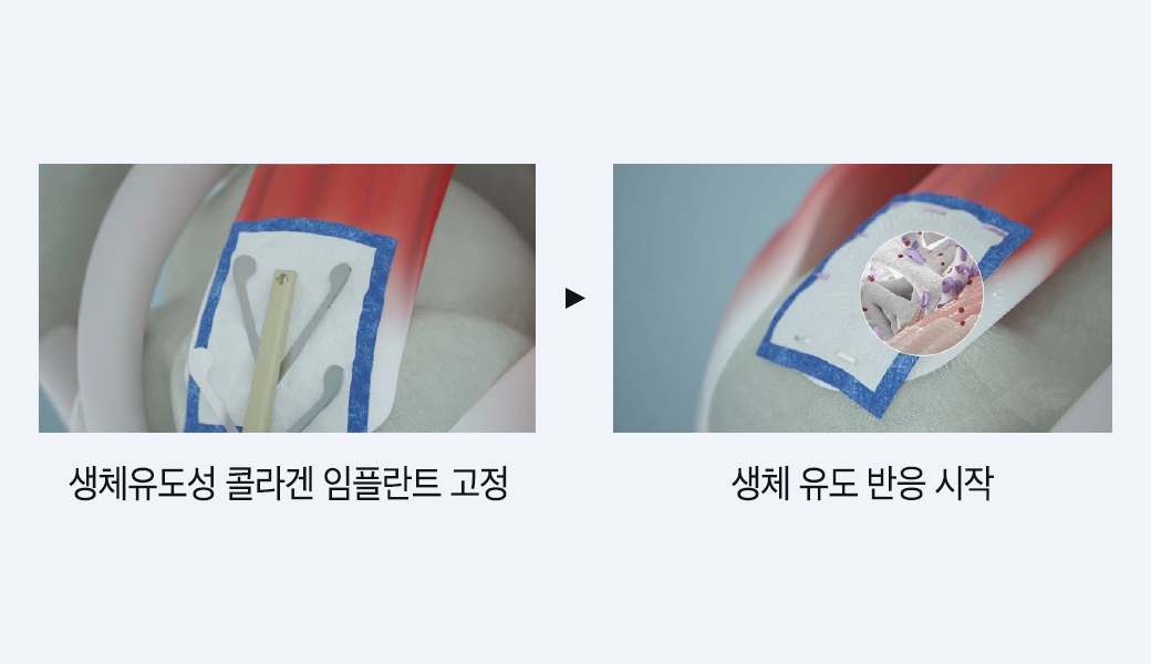 리제네텐 생체유도성 콜라겐 임플란트 이미지